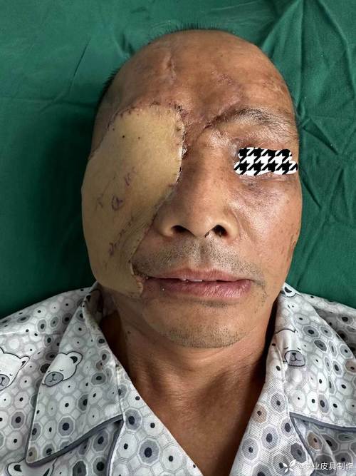 进山采菌被狗熊抓伤-第2张图片-索能光电网